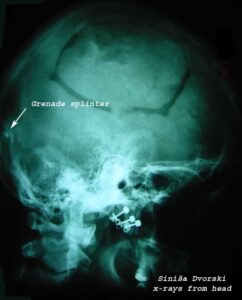 X-ray of the head with grenade fragment